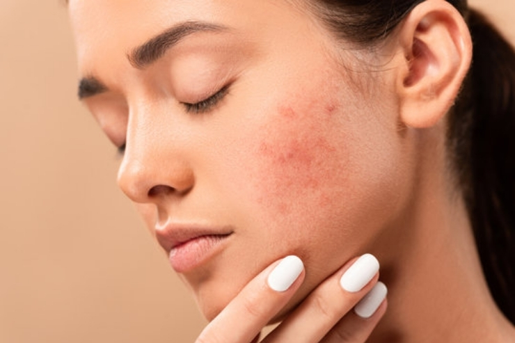 Acne and Related Conditions