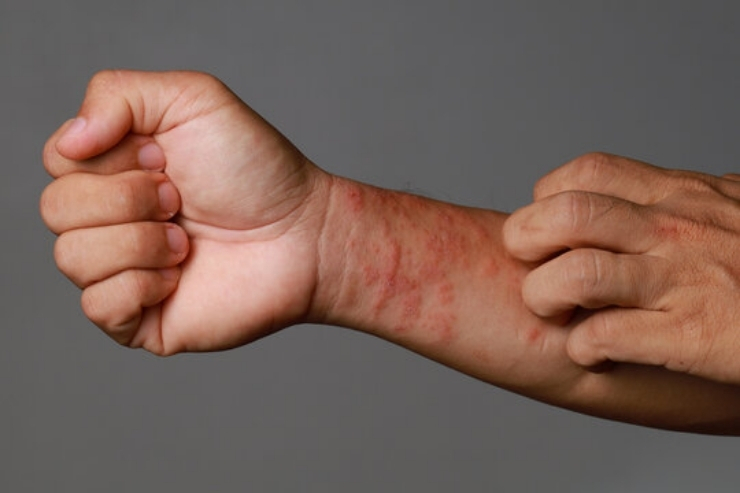 Eczema & Allergic Conditions
