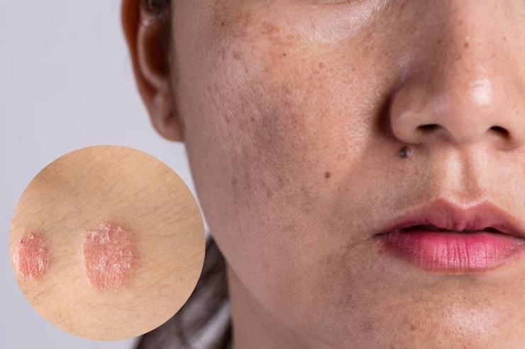 Pigmentation & Skin Disorders